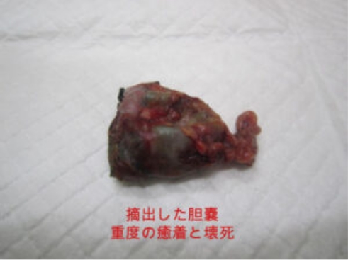 摘出した胆嚢