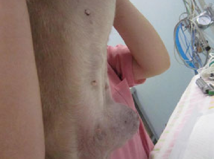 乳頭（ちくび）部に大きなシコリ1