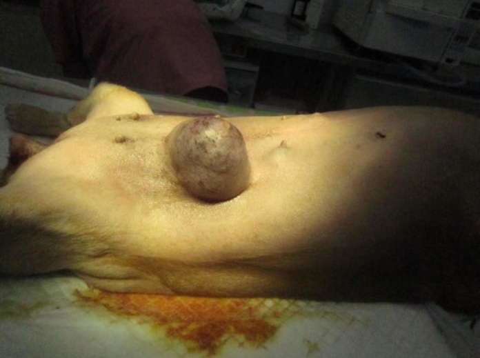 乳頭（ちくび）部に大きなシコリ2